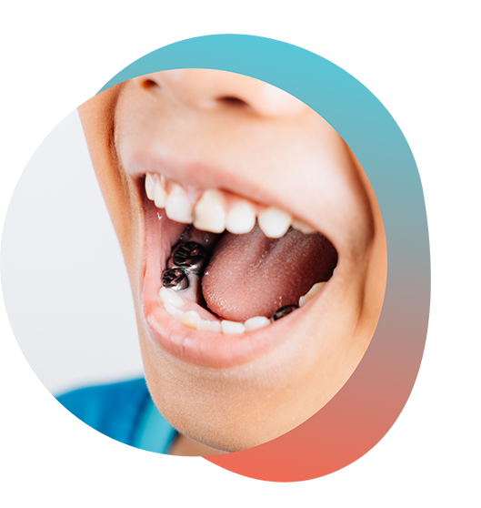 Child opening mouth to show dental crowns on teeth