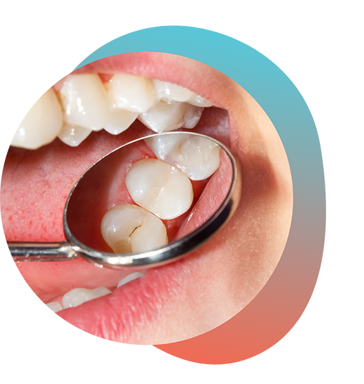 Examining teeth with dental mirror