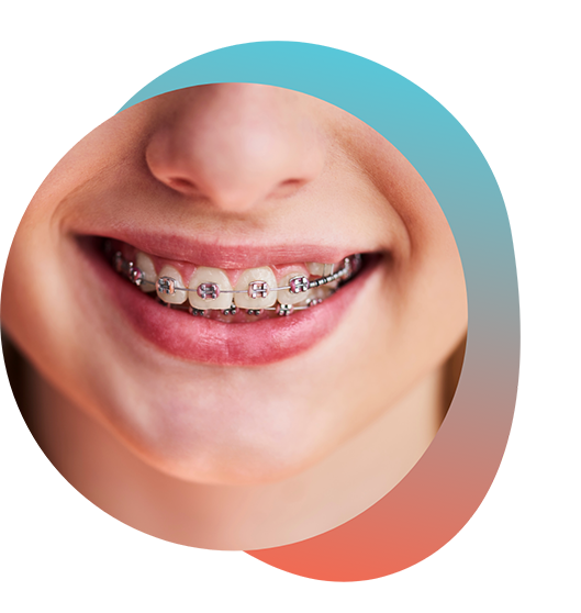 Close up of smile with braces for orthodontics in Rowlett