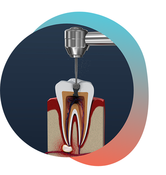 Illustration of tooth receiving root canal treatment in Rowlett