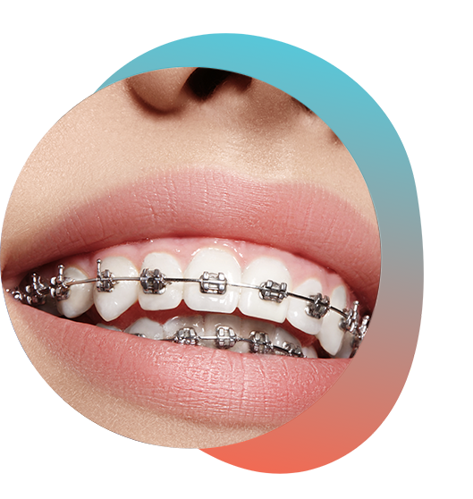 Up-close view of traditional braces