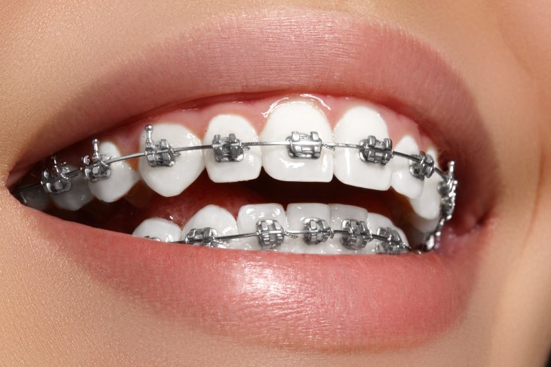 A closeup of a smile with traditional metal braces