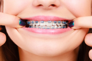 Patient pulling her lips back to reveal blue braces